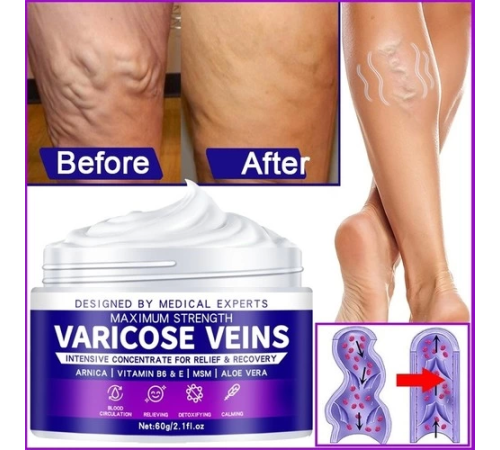 Maximum Strength Varicose Veins Krem 100 ml 1 Adt Maximum Strength Varicose Veins Krem 100 ml 1 Adt