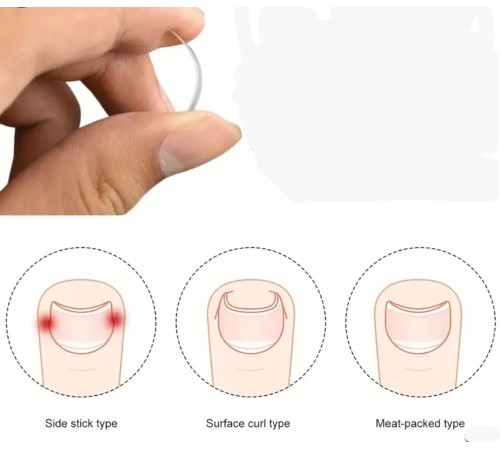 BAŞ PARMAK TIRNAK BATMASINI ENGELLEYEN METAL APARAT NRD 603 ***