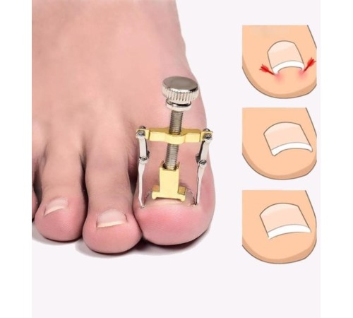 Batık Tırnak Çıkarma Aparatı