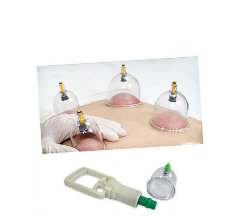 Hacamat Seti - Vakumlu Kupa Çekme Seti (Model 2) Hacamat Seti - Vakumlu Kupa Çekme Seti (Model 2)
